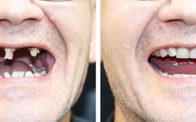 Dental Veneers Teeth Before and After: Real-Life Examples