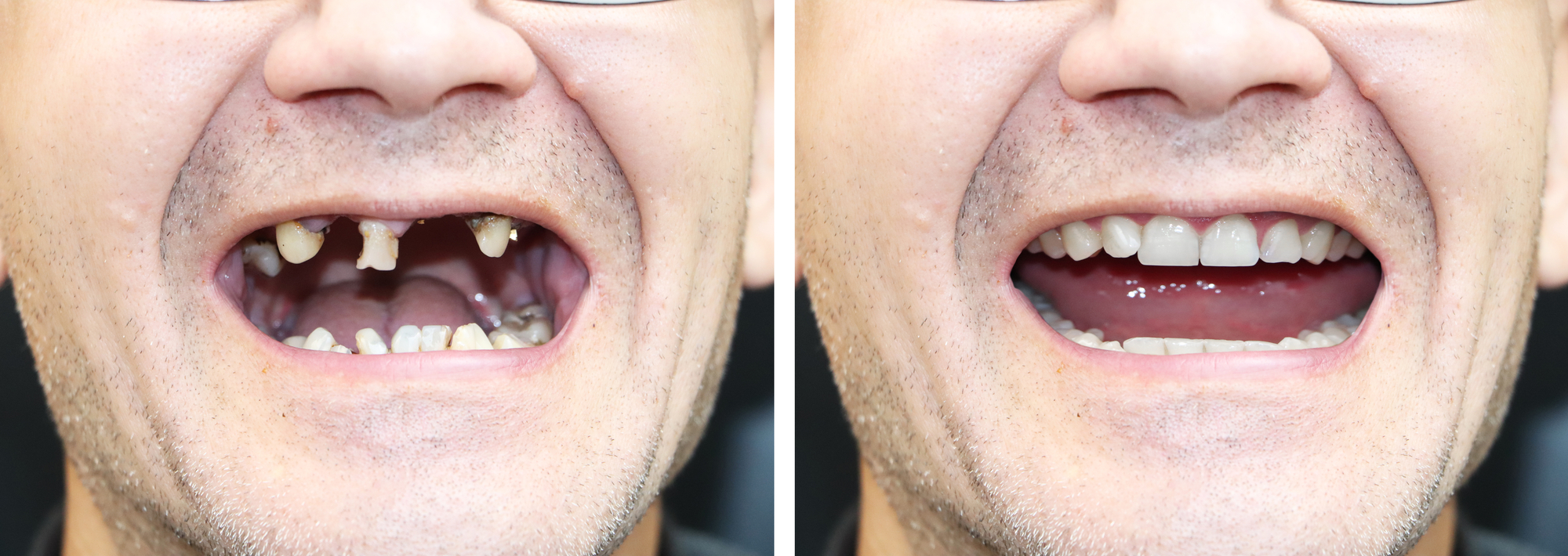 Dental Veneers Teeth Before and After: Real-Life Examples