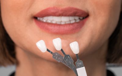 What Are Dental Veneers Made Of: Materials and Composition