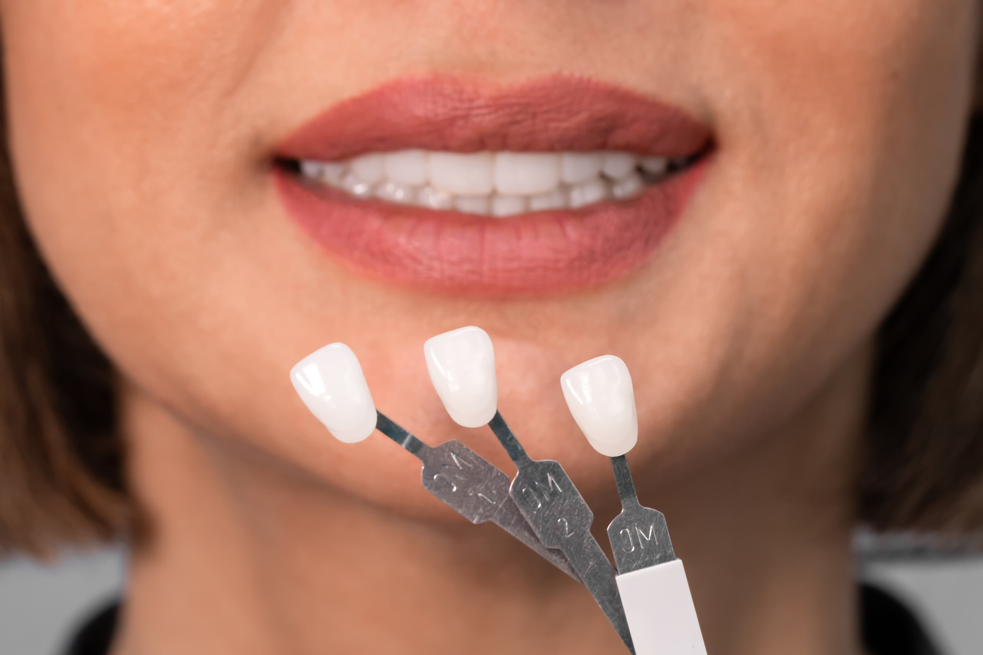 What Are Dental Veneers Made Of: Materials and Composition